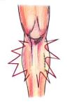 Police sketch of the shin splint that has been terrorizing my legs